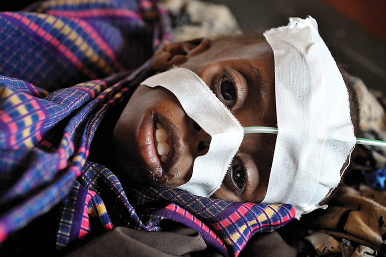 Photo of an African child, lying down, with a feeding tube administering nutrition through his nose